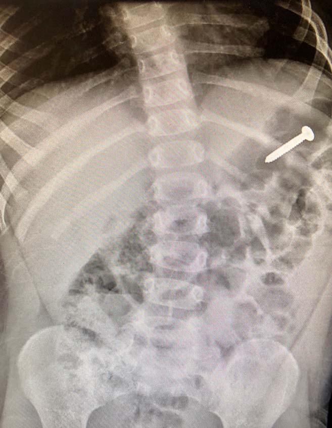 Radiografía o tomografía computarizada del objeto retenido.